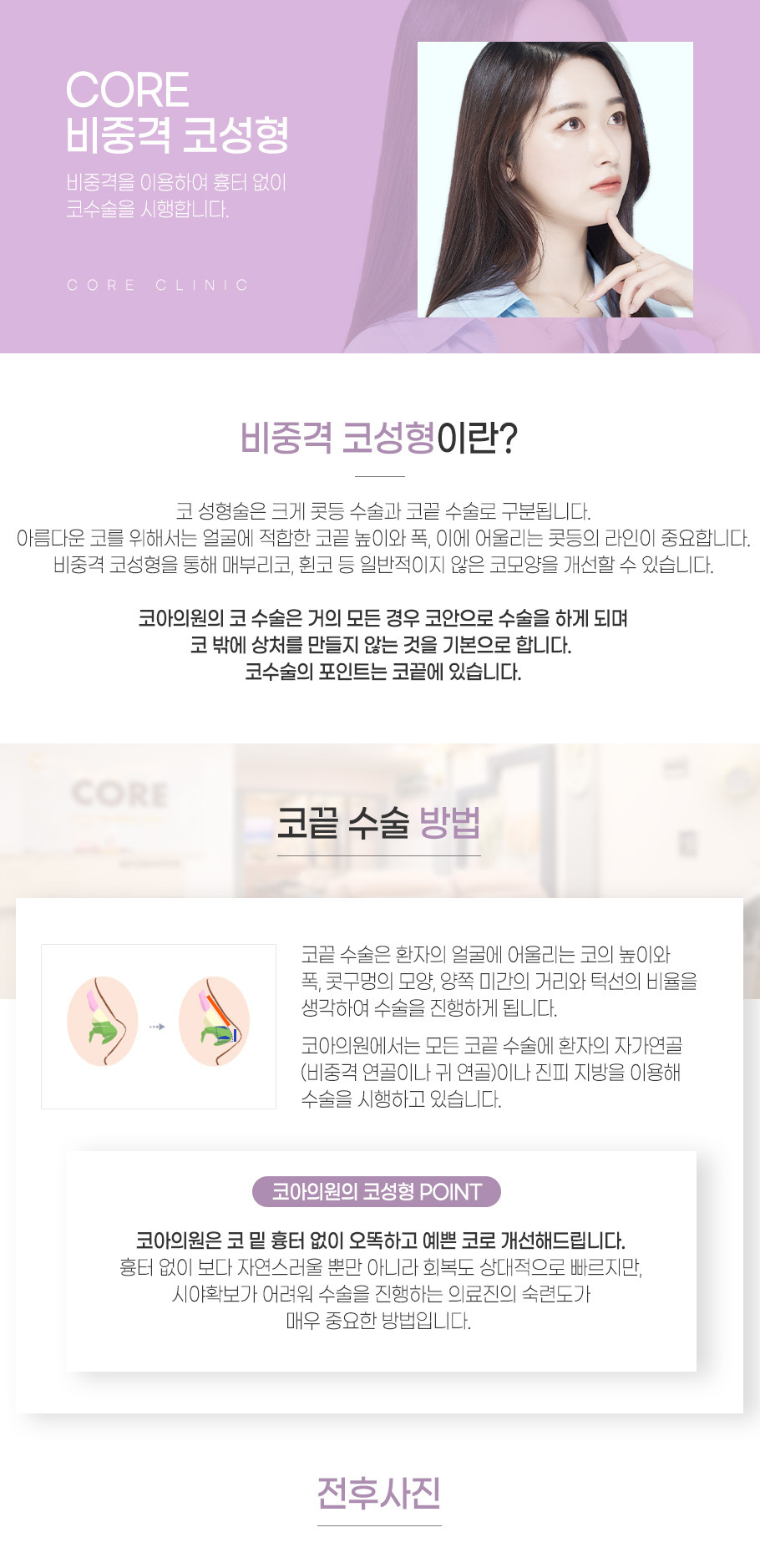 비중격코성형