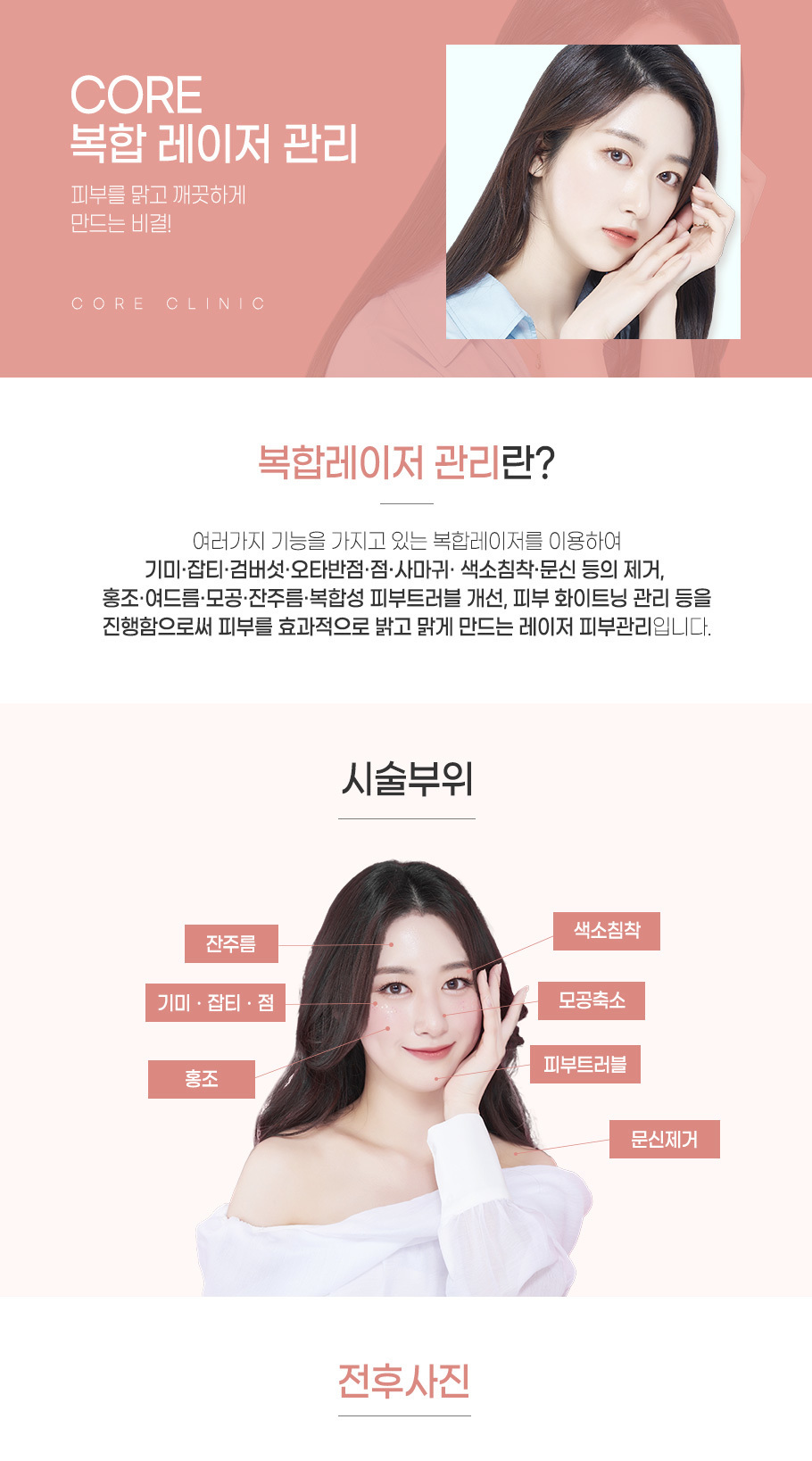 복합레이저관리