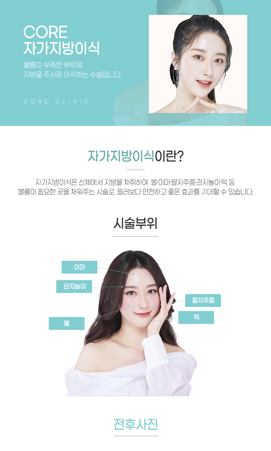 자가지방이식