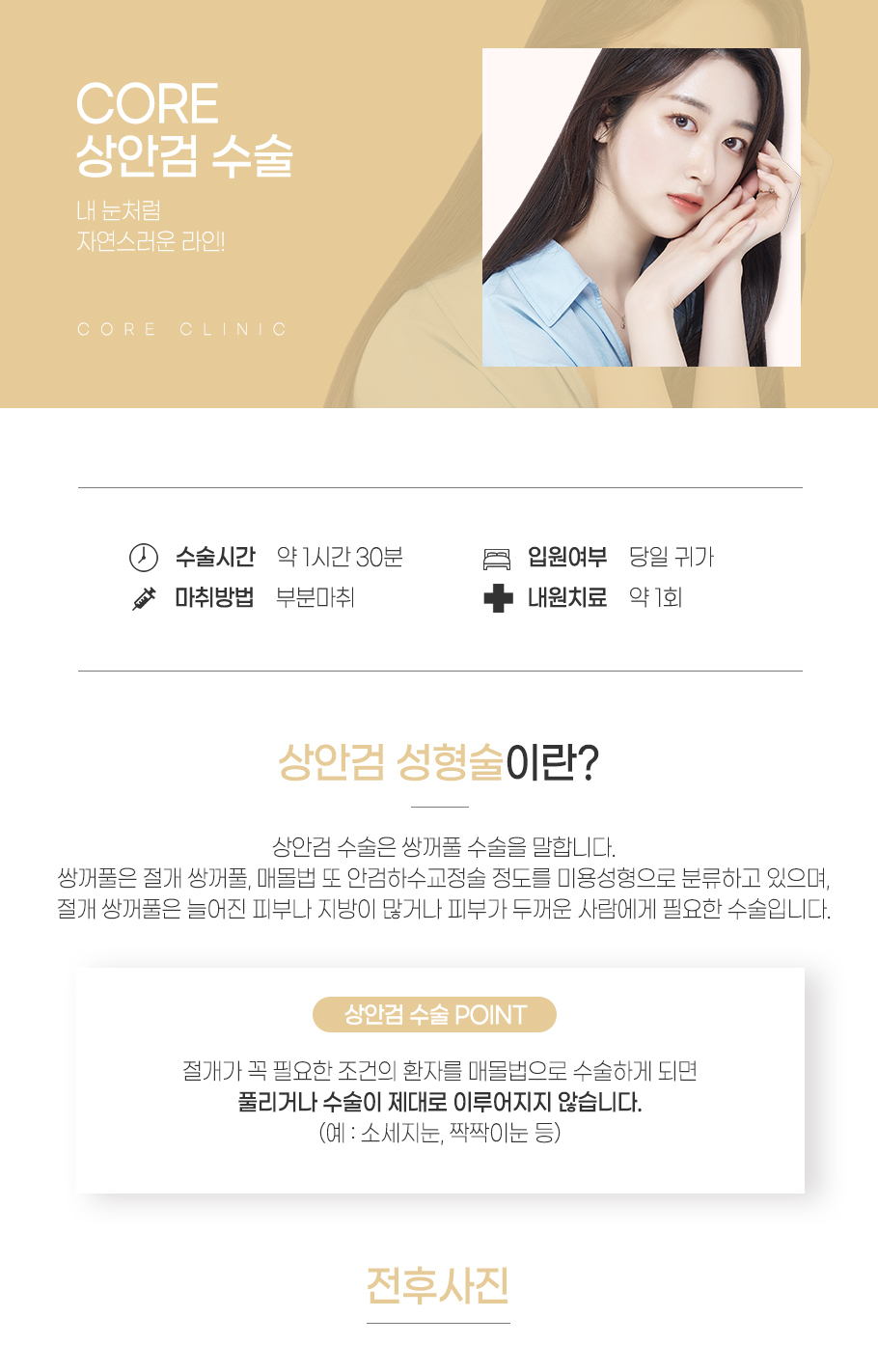 상안검 수술