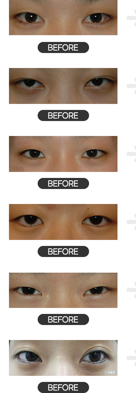 상안검수술