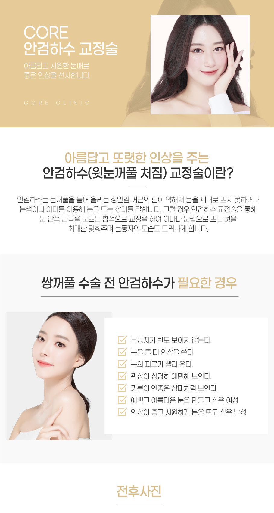 안검하수교정수술