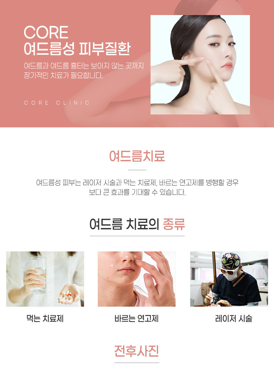 여드름성 피부질환
