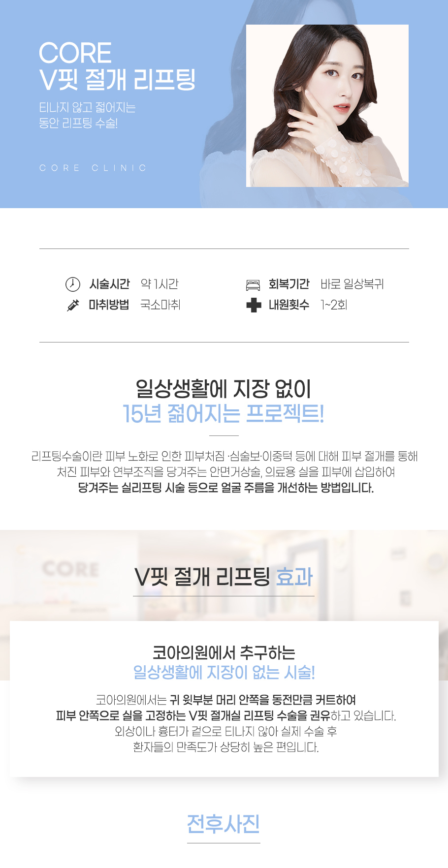 V핏 절개리프팅