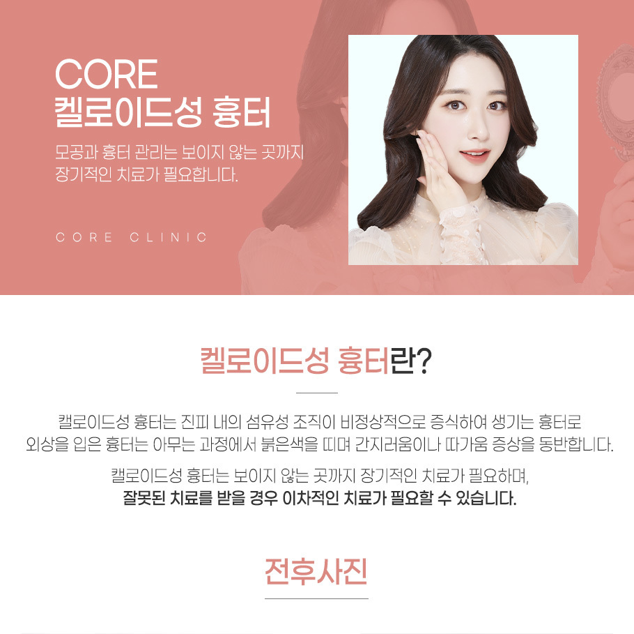 모공흉터관리