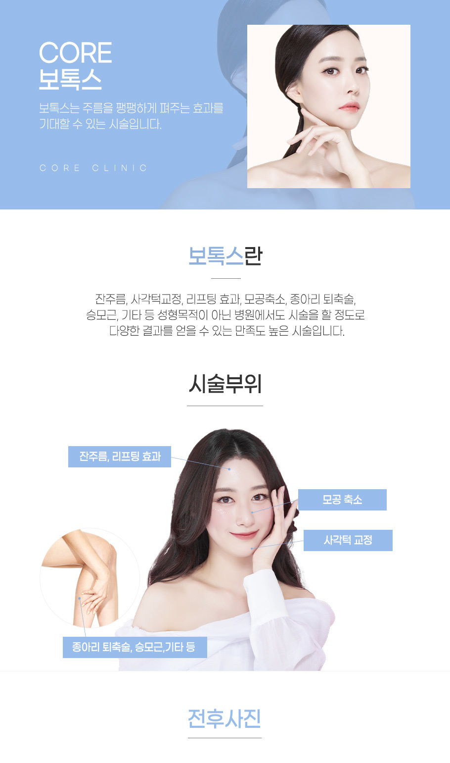 보톡스