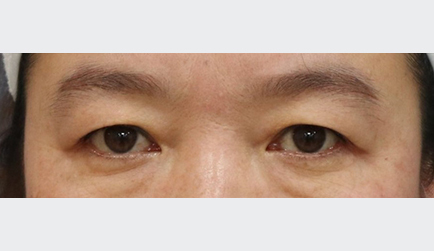 눈썹거상술