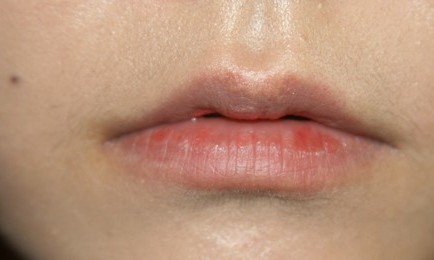 쁘띠시술