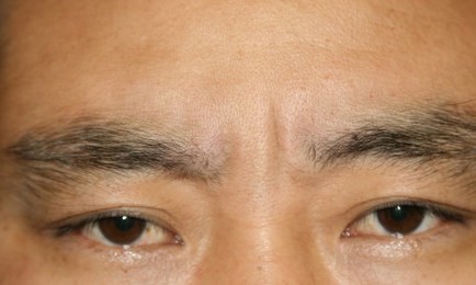 쁘띠시술