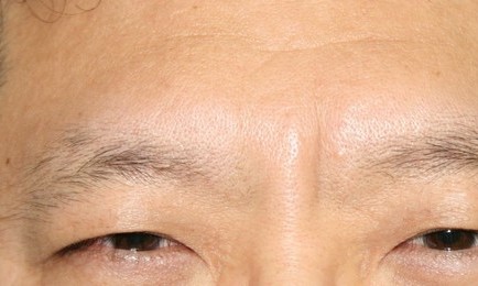 쁘띠시술