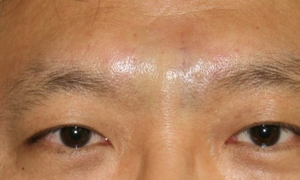 쁘띠시술